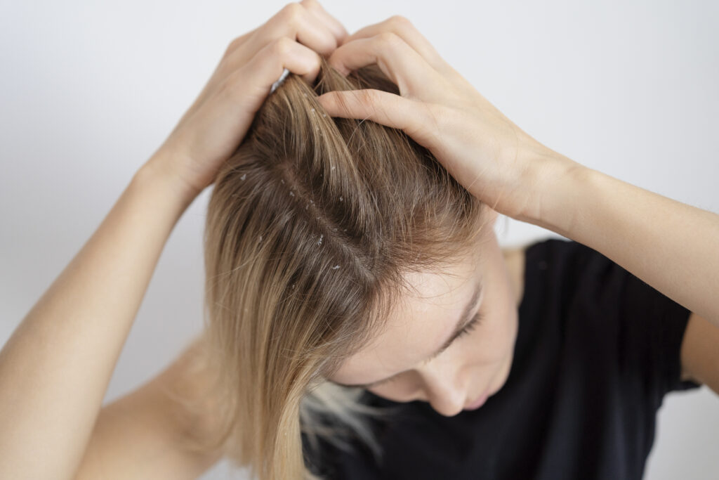 Telogen Effluvium vs. Other Hair Loss Conditions