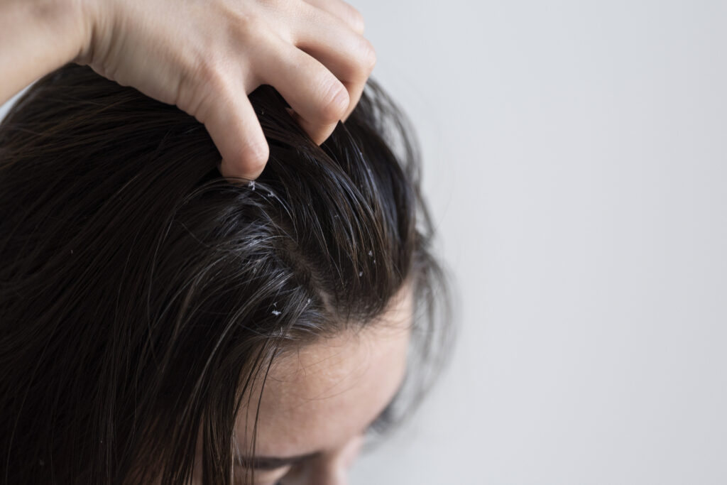 Banish Dandruff