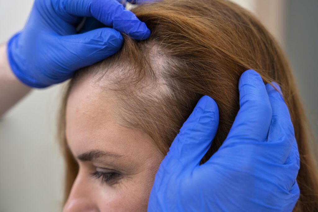 Trichology Treatment for Thin Hair