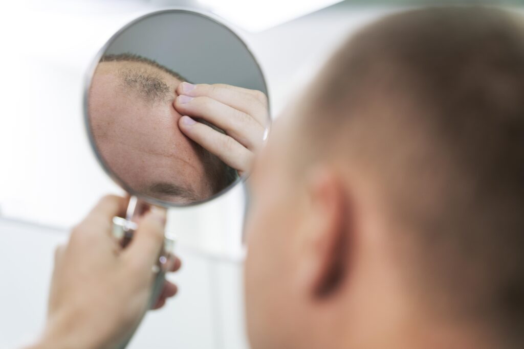 male pattern baldness