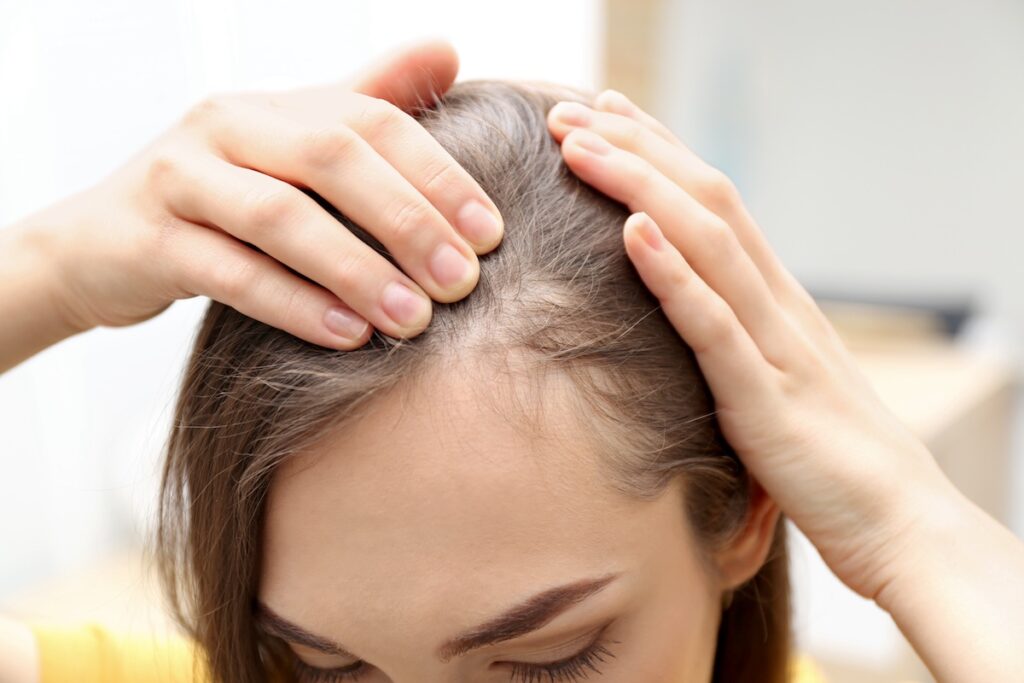 Telogen-Effluvium-vs-Alopecia-Areata